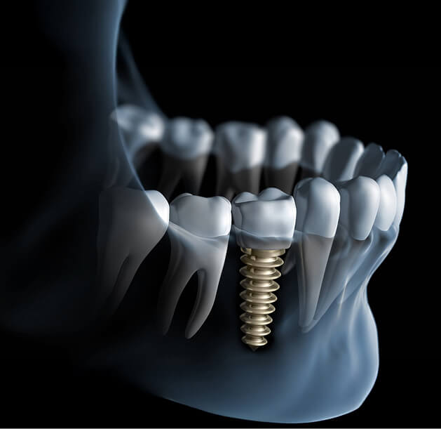 implanty zębów gdańsk