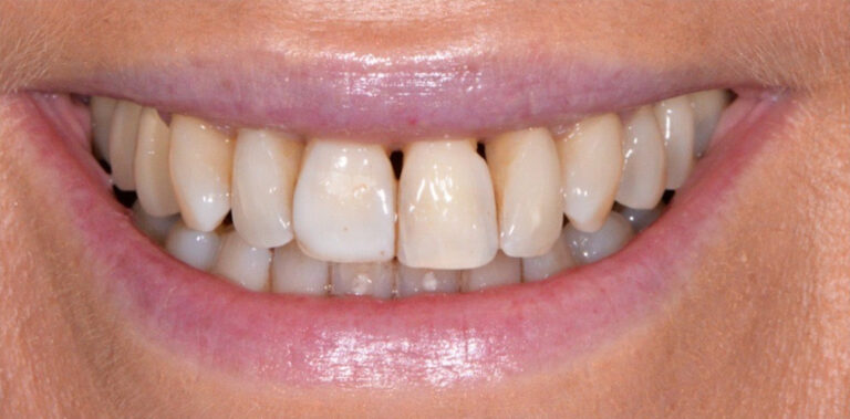 Метаморфоза 90 - przed