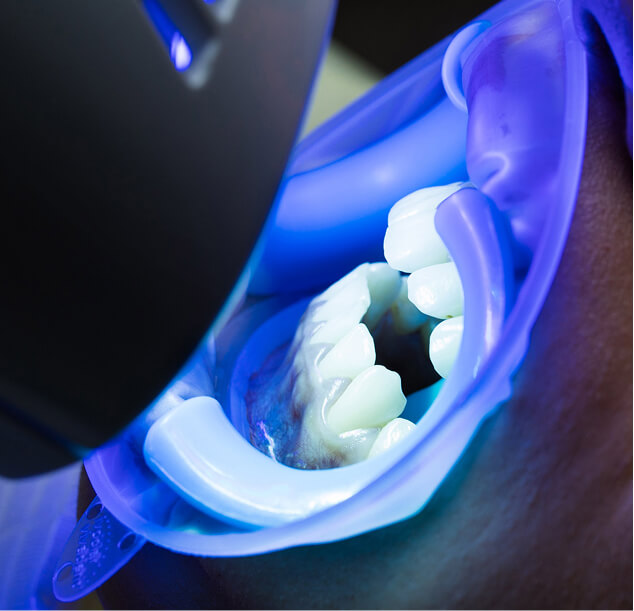 wybielanie zębów gdańsk