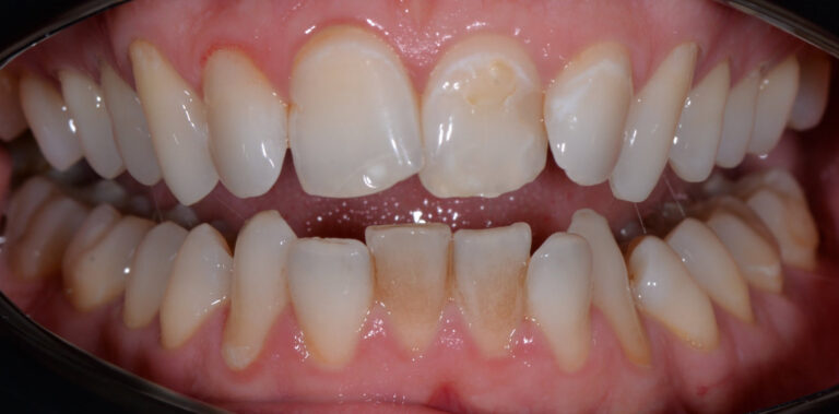 Метаморфоза 75 - przed