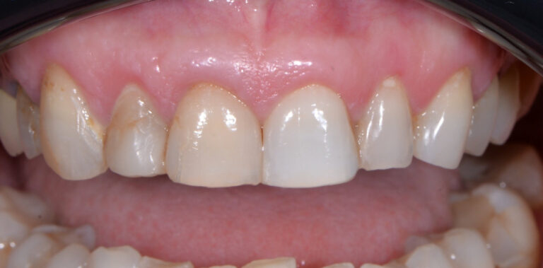 Метаморфоза 93 - przed