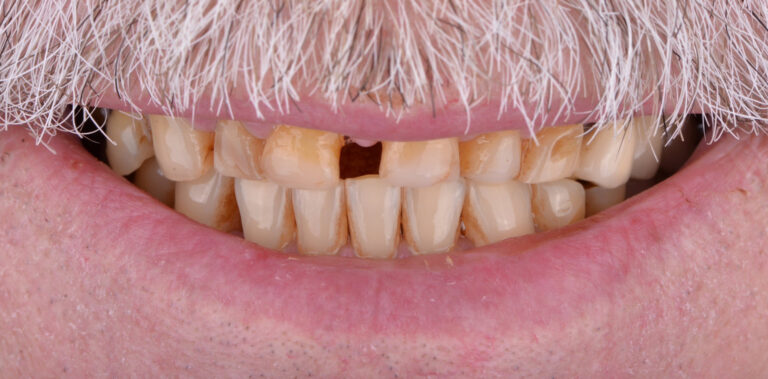 Метаморфоза 64 - przed