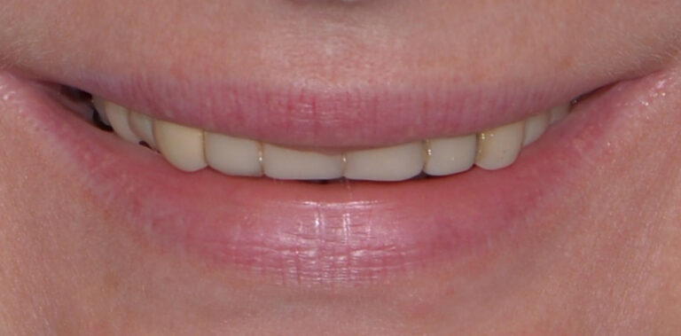 Метаморфоза 65 - przed