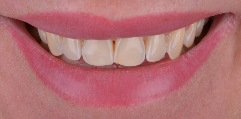 Метаморфоза 22 - przed