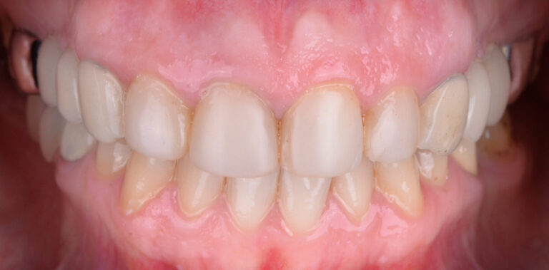 Метаморфоза 46 - przed