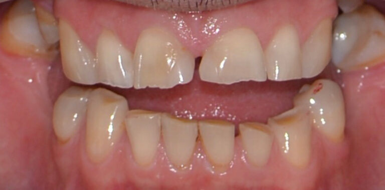 Метаморфоза 85 - przed