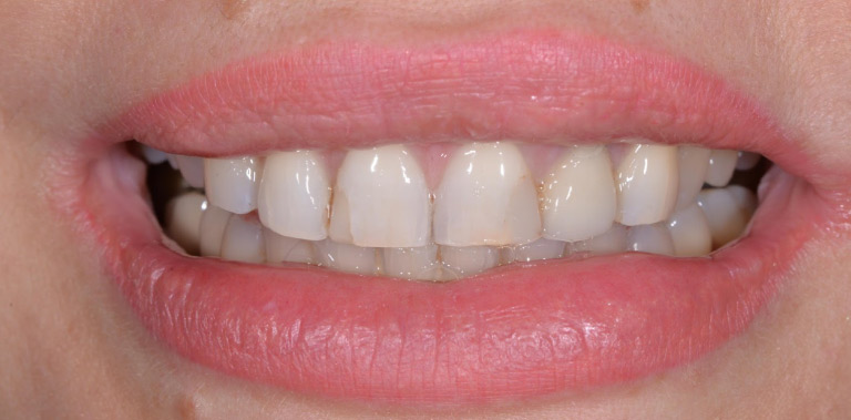 Метаморфоза 25 - przed